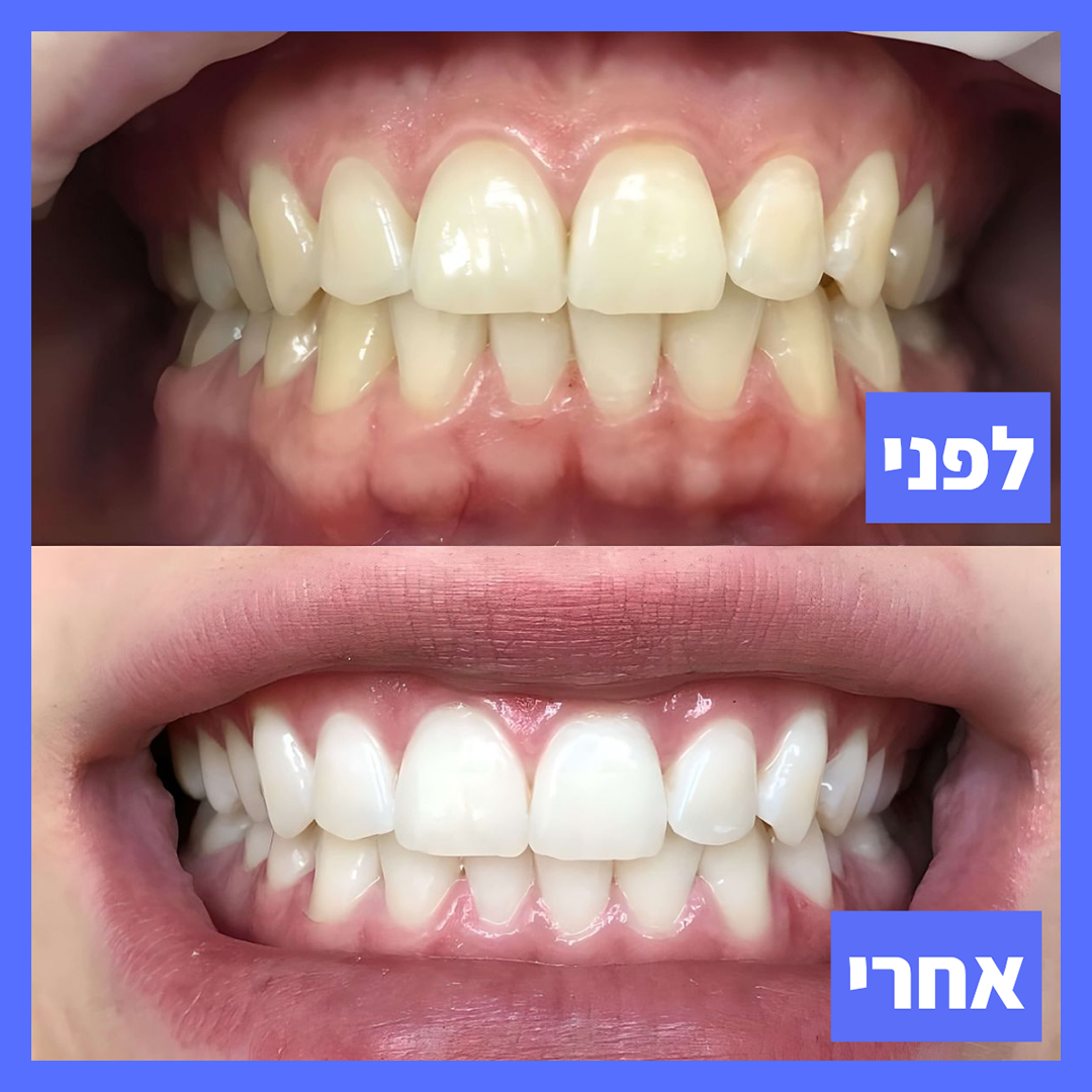מברשת השיניים הבריאה מבית AuraOne - מונעת ריח רע מהפה, ושיניים צהובות, ב30 שניות ללא מאמץ